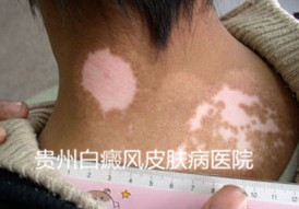 ���粢�ǲ���֢֮��Ӧ����Ԥ��