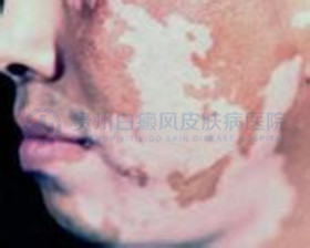 ɢ���Ͱ��絽�����ڵ�֢״��ʲô��