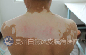 �����װ߲���֢״��ʲô