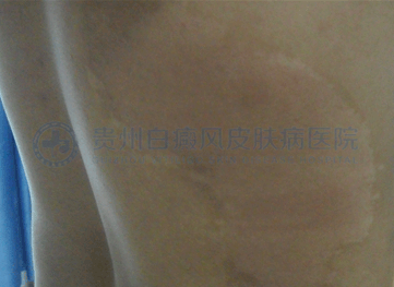 男性背部局限型白癜风5年