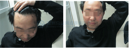 男性1年白癜风在我院3个月康复