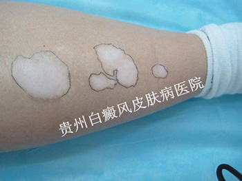 �Ȳ������֢״��ʲô��