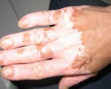 ����֢״ͼƬ������֢״��ʲô