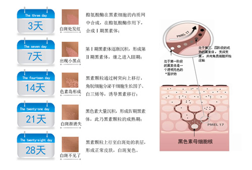 成人白癜风能治好吗