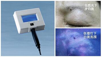 如何判断手上白斑是否为白癜风