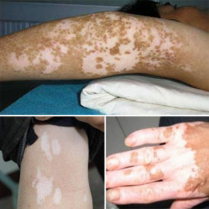 如何判断手上白斑是否为白癜风